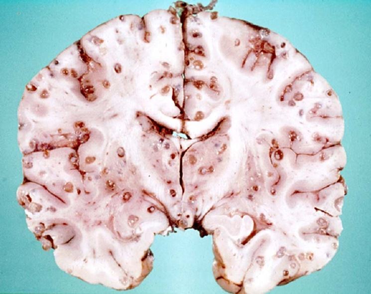 Radiografia di cisticercosi cerebrale
