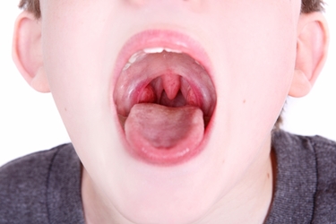 Bambino con tonsille infiammate