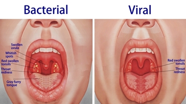 Differenza tonsillite virale e batterica