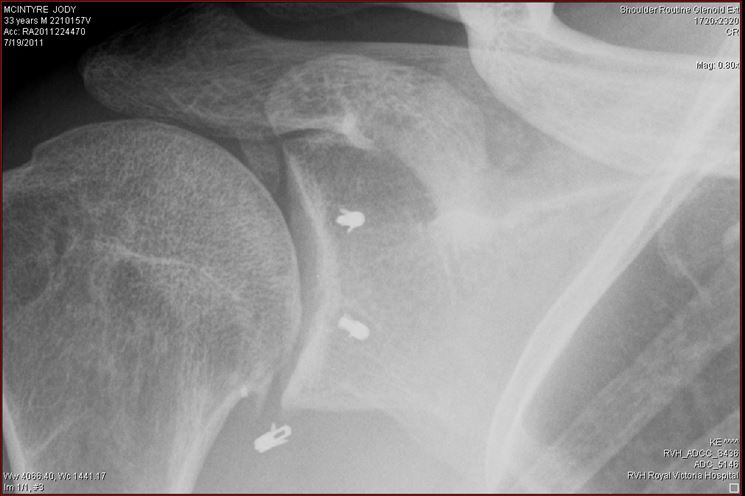 Radiografia articolazione spalla