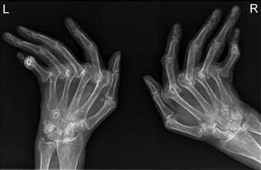 Radiografia di artrite reumatoide