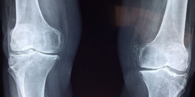 Radiografia ginocchio