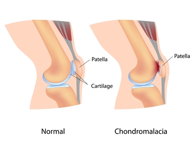 condropatia rotulea