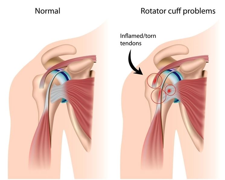 Infiammazione cuffia rotatori