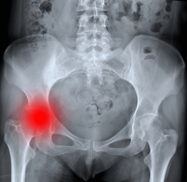 radiografia rottura del femore