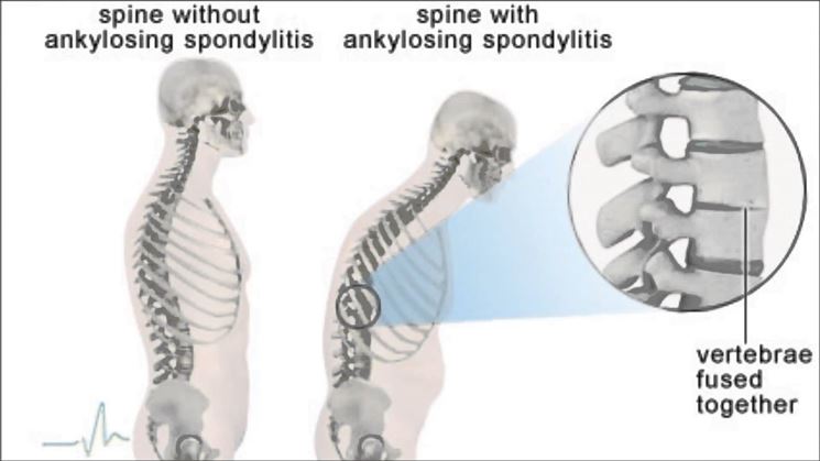 Vertebre deformate