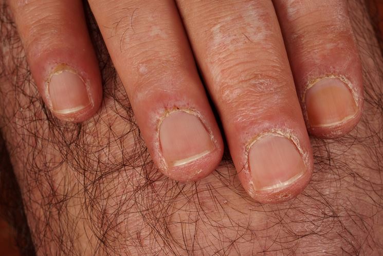 Sindrome raynauds