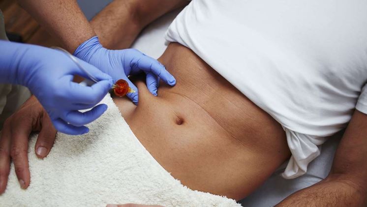 Utilizzo mesoterapia