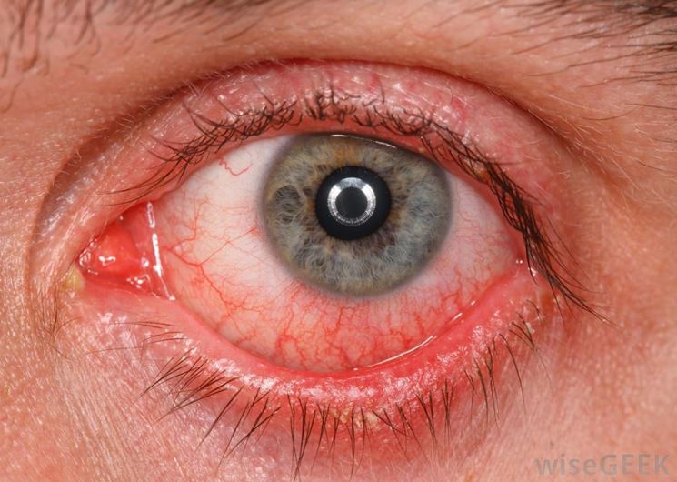 Conseguenze dell'ipertensione sugli occhi